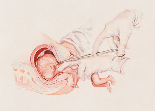 FOCA - brutalna aborcja - Barack Obama rzeźnikiem Ameryki?